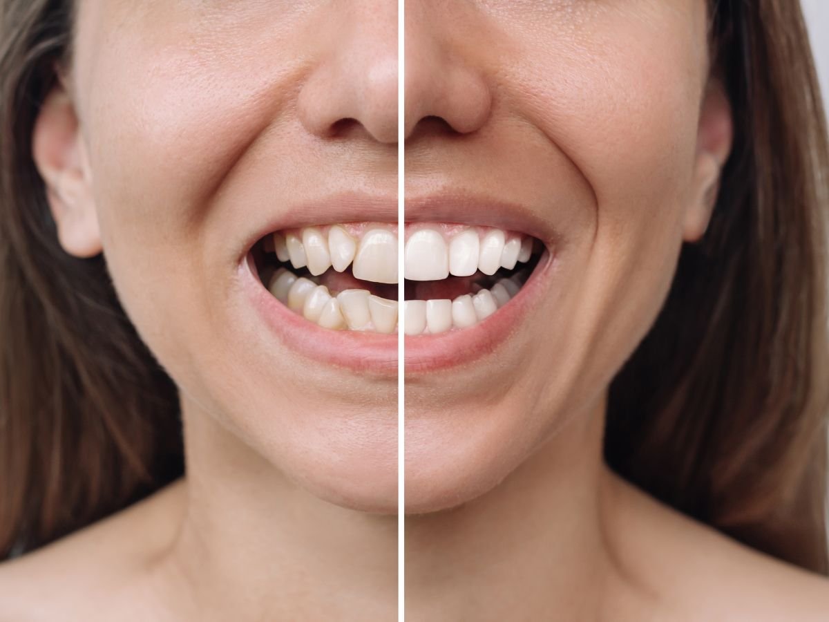 Before and after dental veneers for a female patient at OraCore Dental in Odenton, MD, showing improved smile and natural-looking veneer results